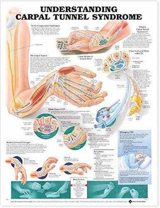 Understanding Carpal Tunnel Syndrome Chart : Heavy Paper