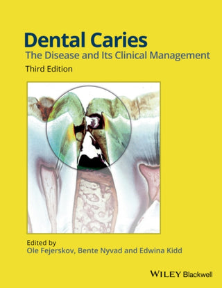 Dental Caries : The Disease and its Clinical Management