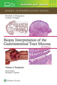 Biopsy Interpretation of the Gastrointestinal Tract Mucosa : Volume 2 Neoplastic